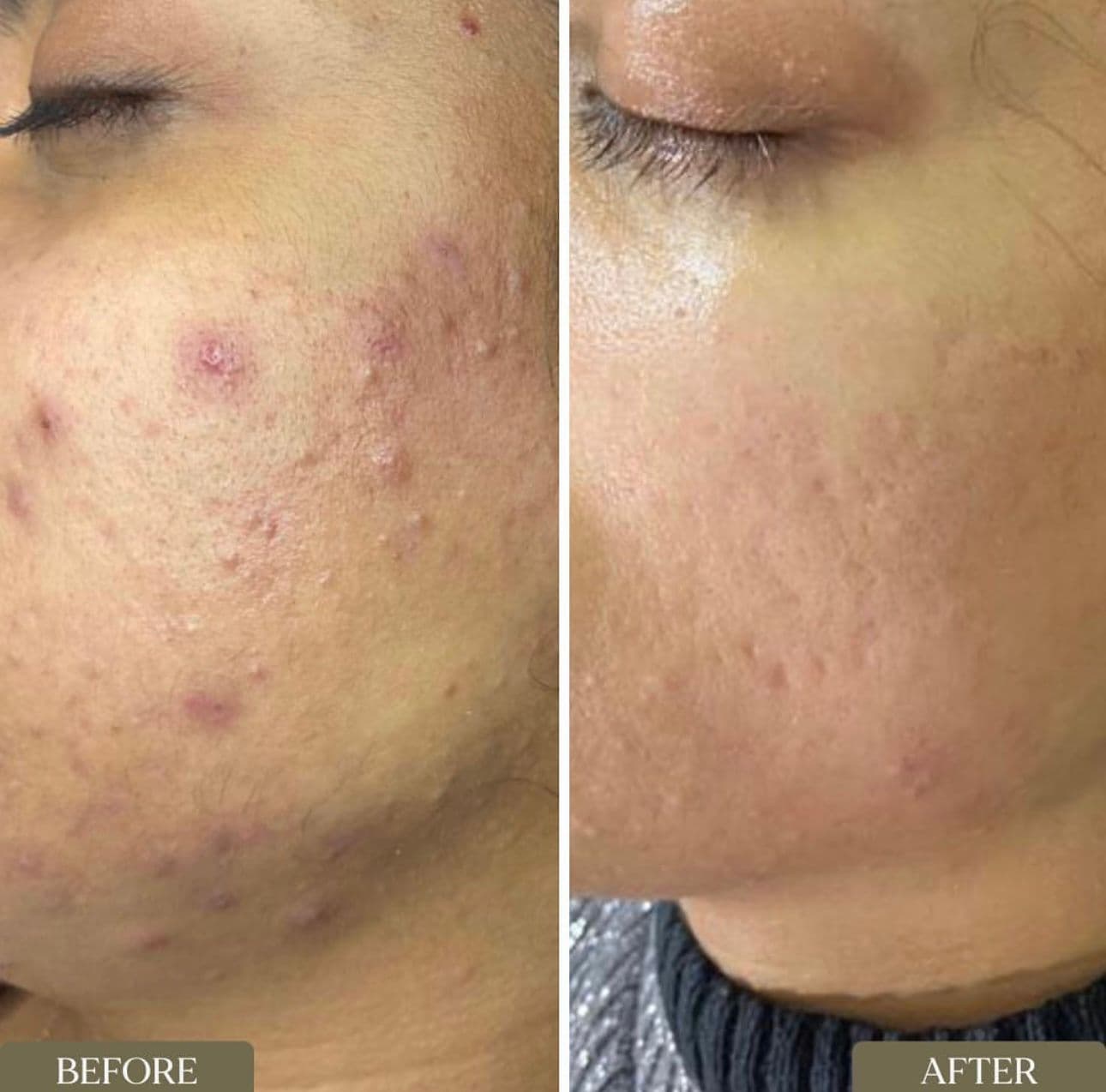 Acne Behandeling